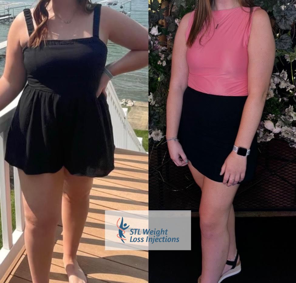 Before and After Semaglutide Weight Loss Injections in St. Louis