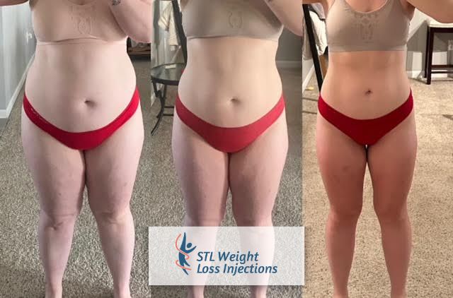 Weight Loss Injection for a female in St. Louis, MO