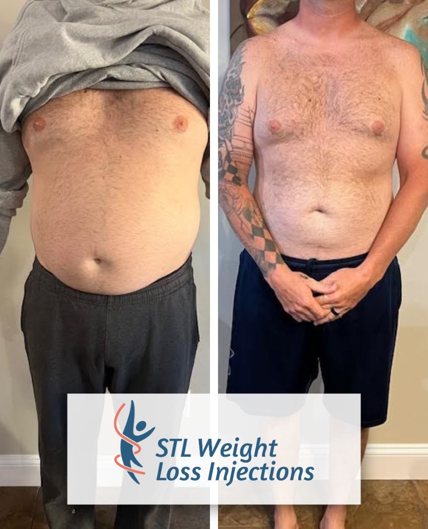Before and After Weight Loss Injections with STL Weight Loss 